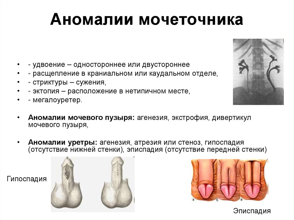 Аномалии мочеточника