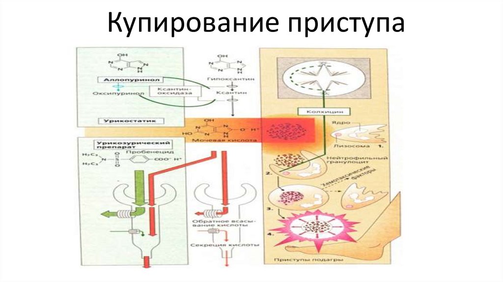 Купирование приступа