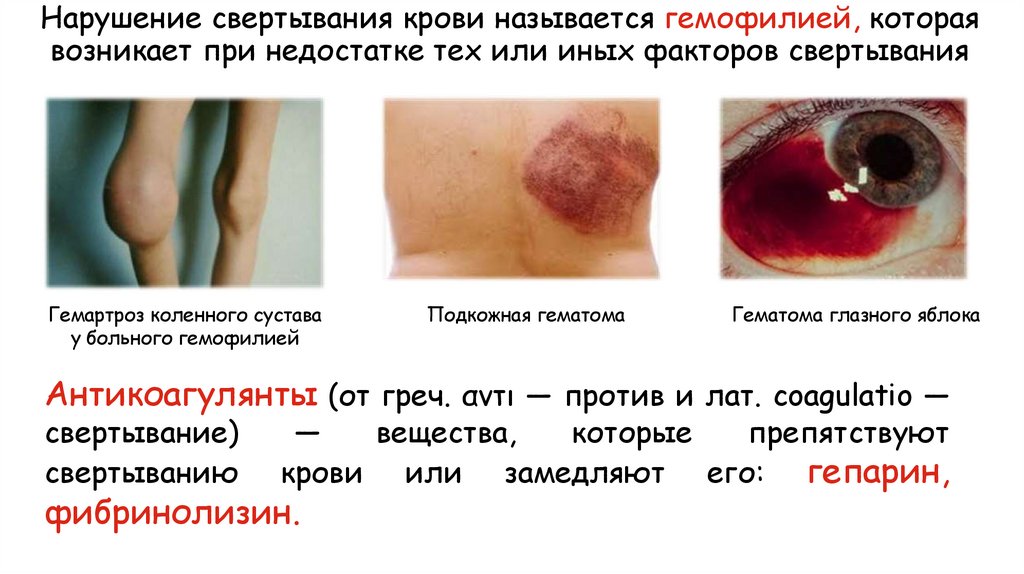 Нарушение свертывания крови называется гемофилией, которая возникает при недостатке тех или иных факторов свертывания