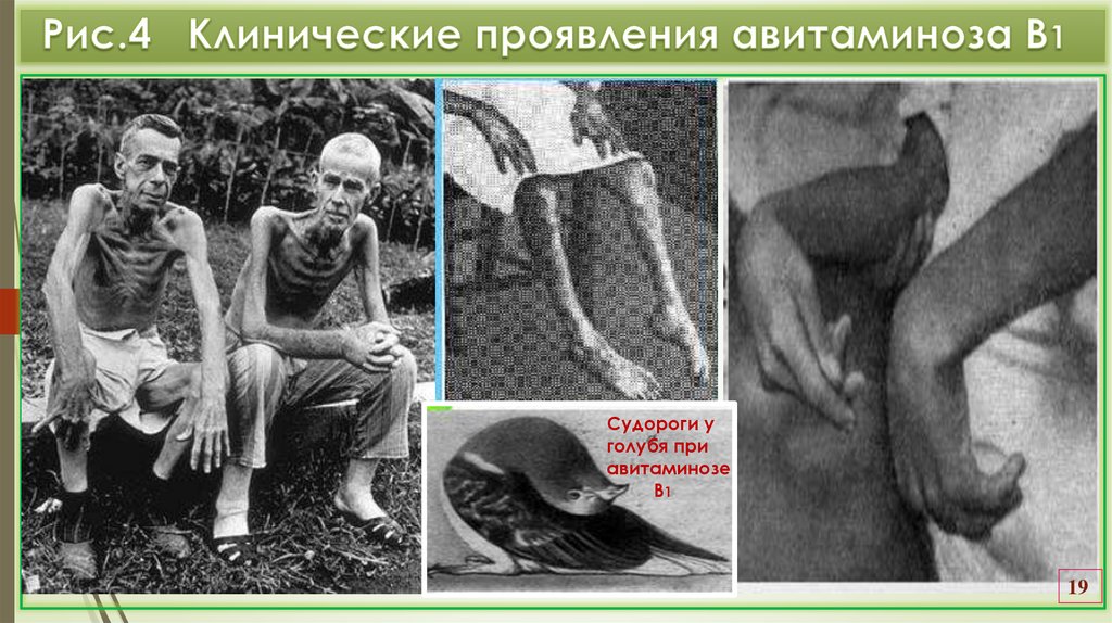 Рис.4 Клинические проявления авитаминоза В1