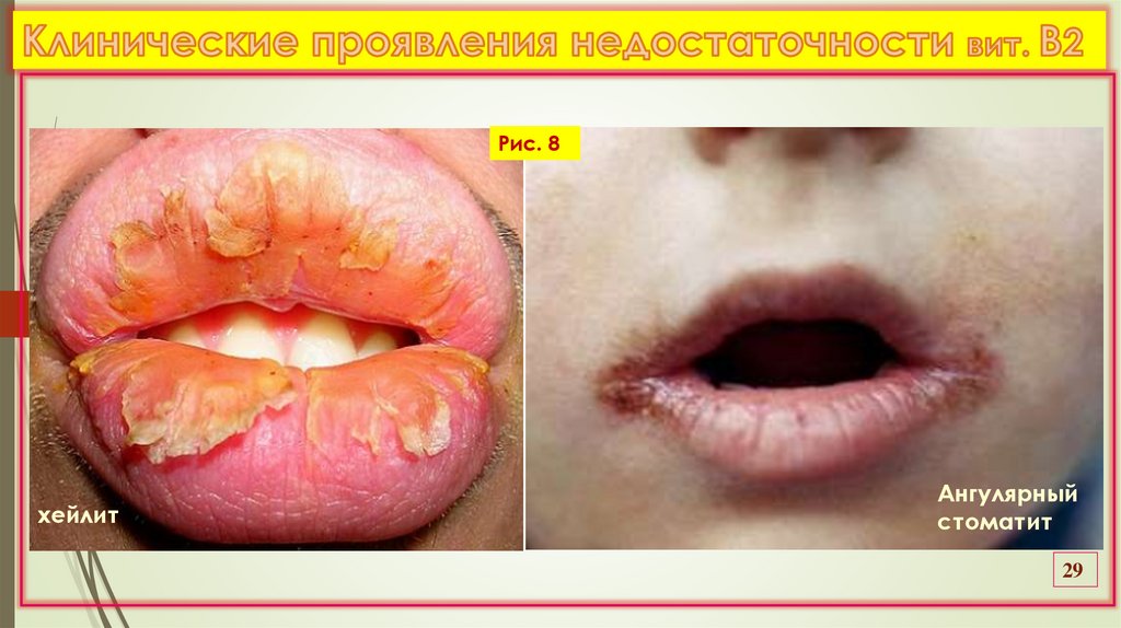 Клинические проявления недостаточности вит. В2