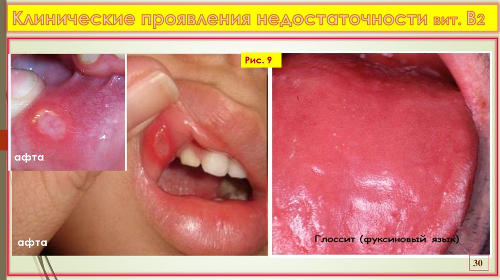 Клинические проявления недостаточности вит. В2