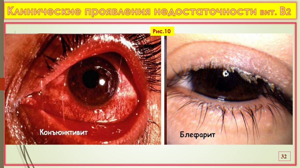 Клинические проявления недостаточности вит. В2