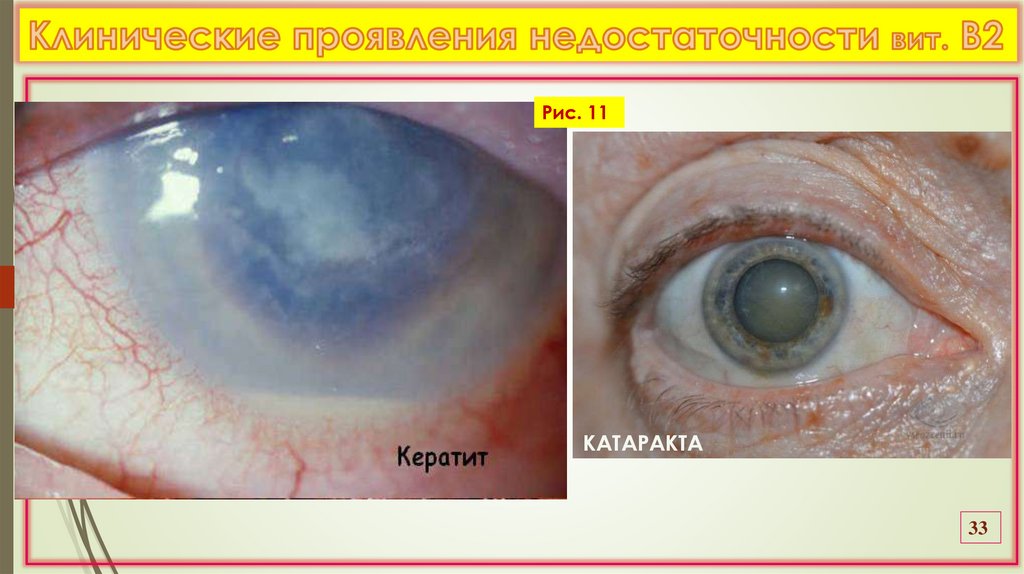 Клинические проявления недостаточности вит. В2