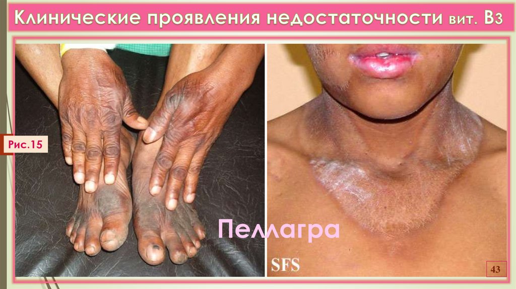 Клинические проявления недостаточности вит. В3