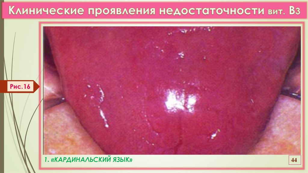 Клинические проявления недостаточности вит. В3