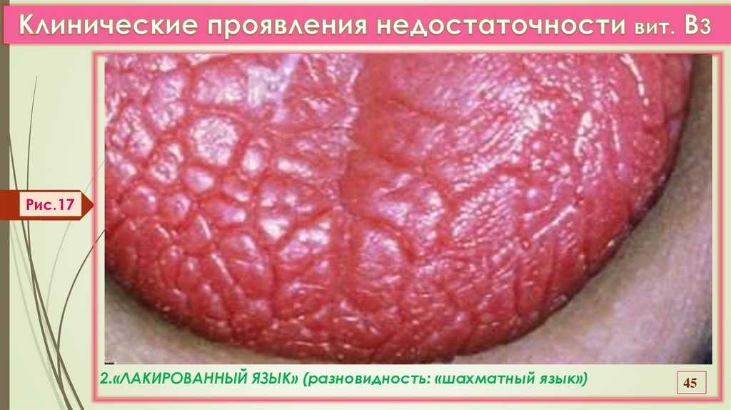 Клинические проявления недостаточности вит. В3