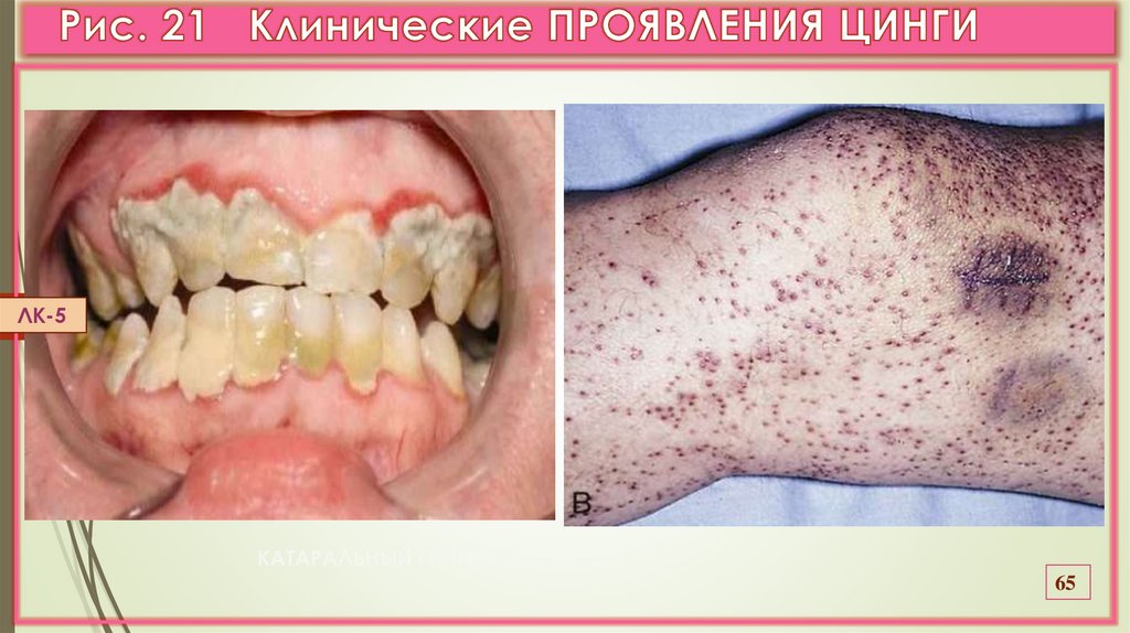 Рис. 21 Клинические ПРОЯВЛЕНИЯ ЦИНГИ