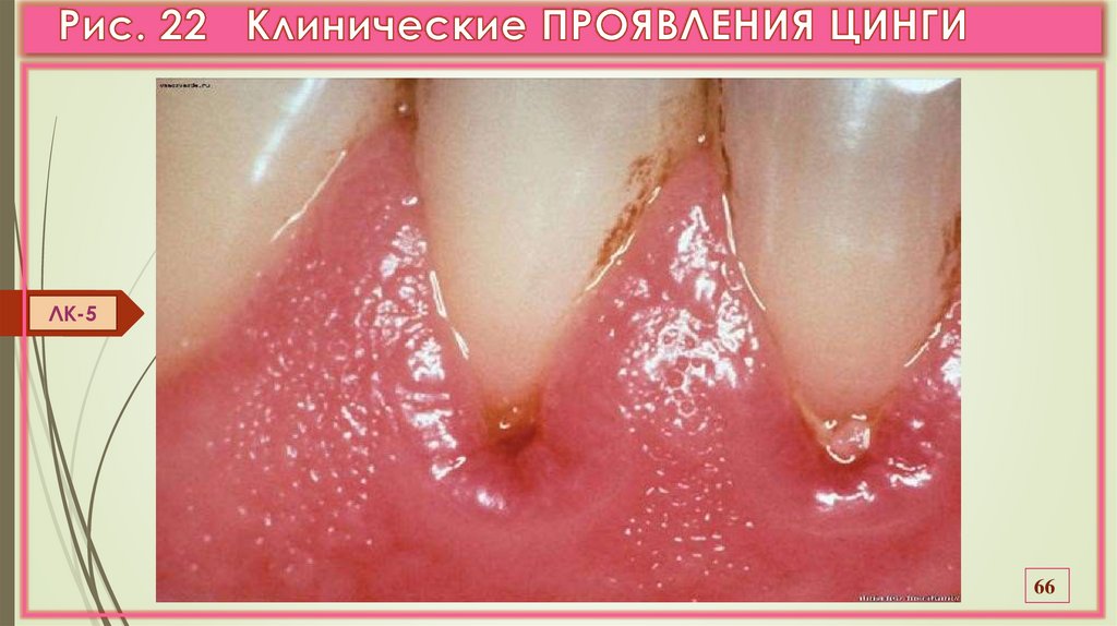 Рис. 22 Клинические ПРОЯВЛЕНИЯ ЦИНГИ