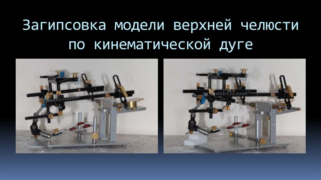 Загипсовка модели верхней челюсти по кинематической дуге