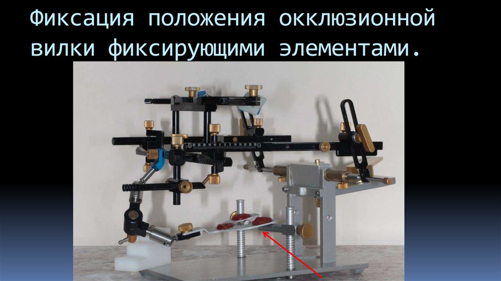 Фиксация положения окклюзионной вилки фиксирующими элементами.