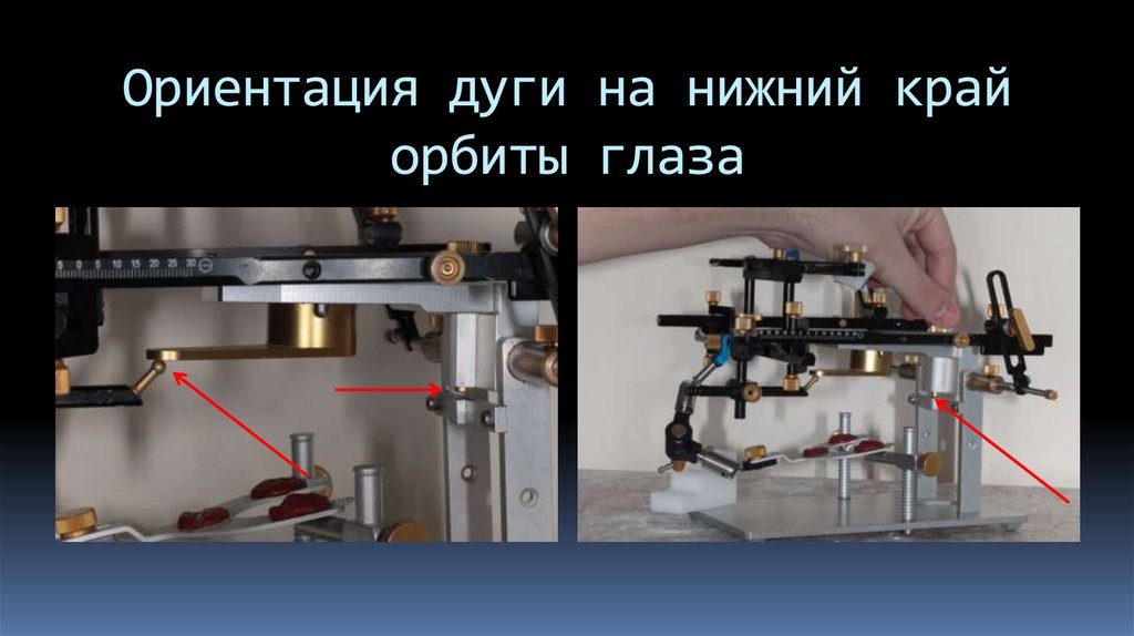 Ориентация дуги на нижний край орбиты глаза
