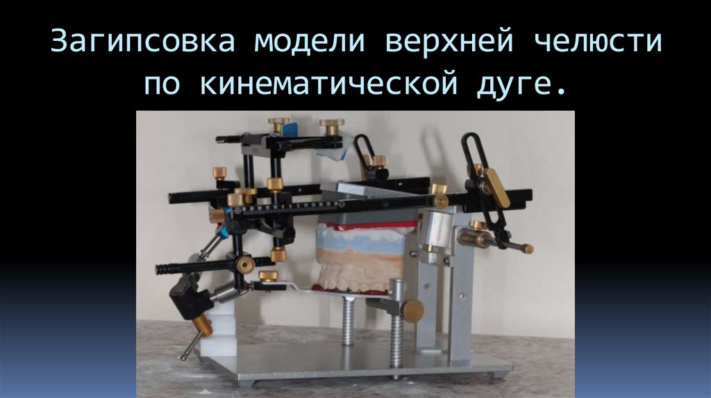Загипсовка модели верхней челюсти по кинематической дуге.