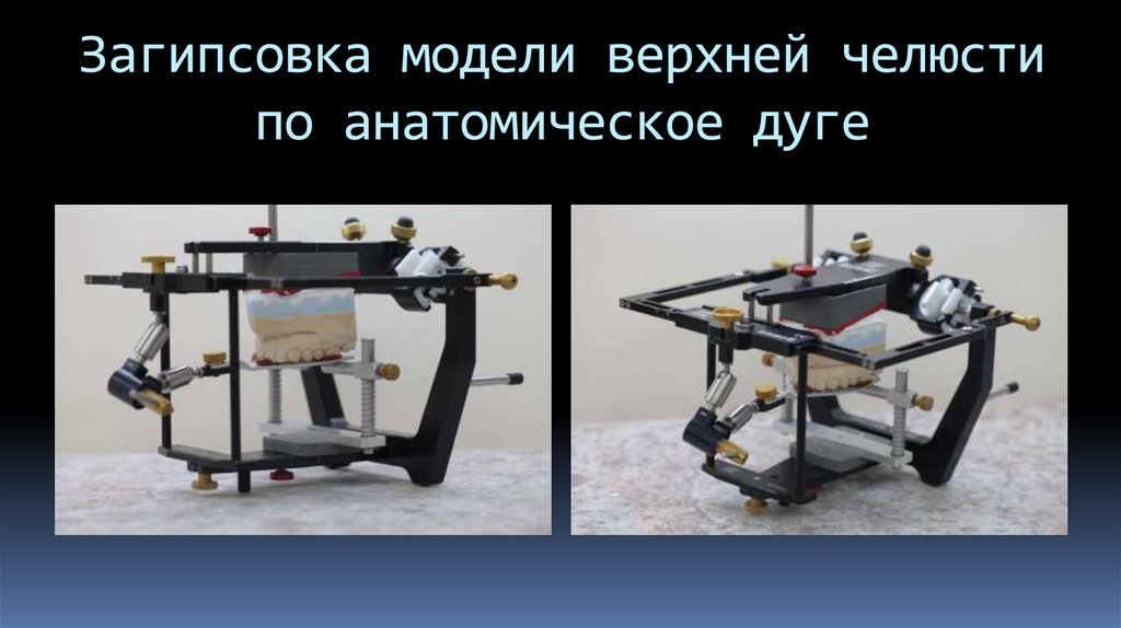 Загипсовка модели верхней челюсти по анатомическое дуге