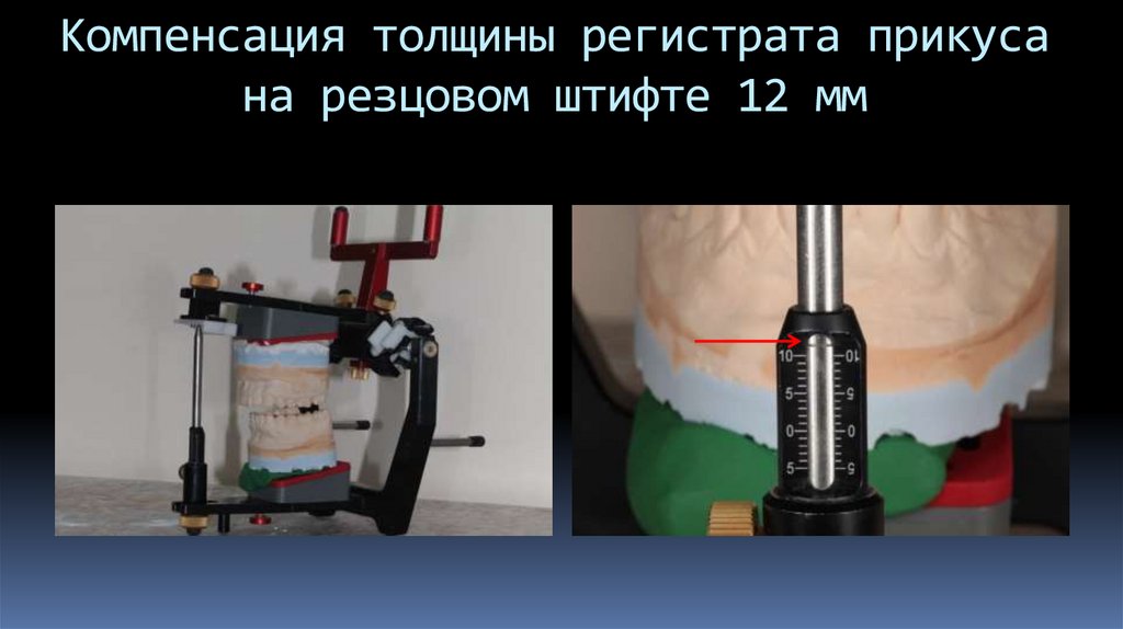 Компенсация толщины регистрата прикуса на резцовом штифте 12 мм