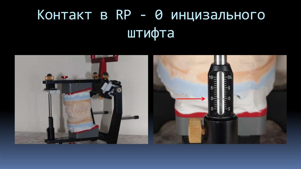 Контакт в RP - 0 инцизального штифта