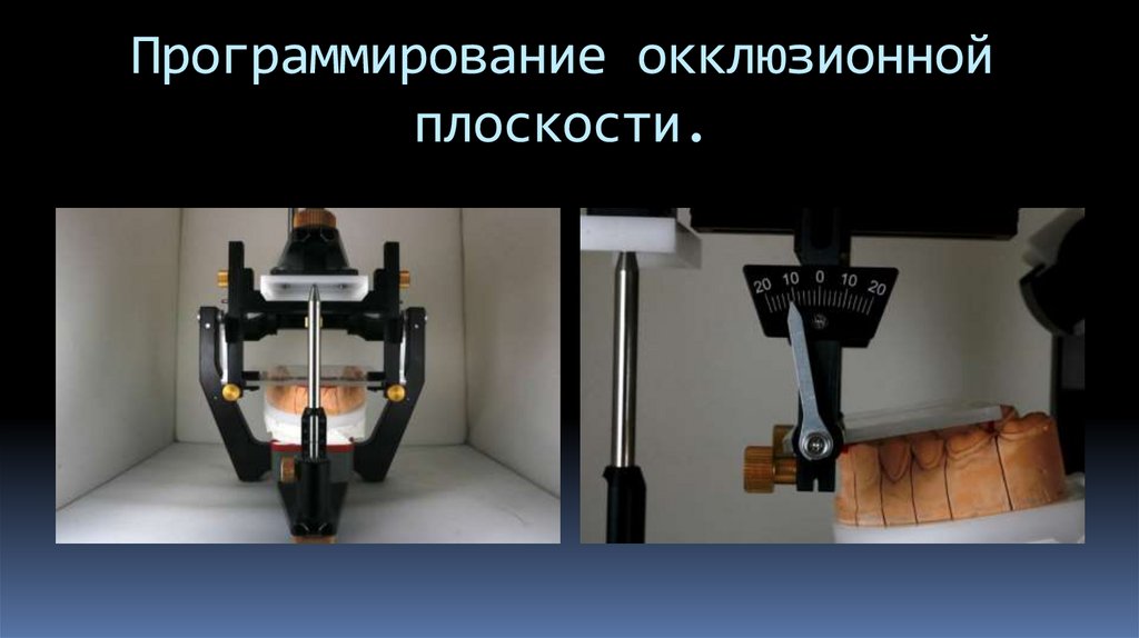 Программирование окклюзионной плоскости.