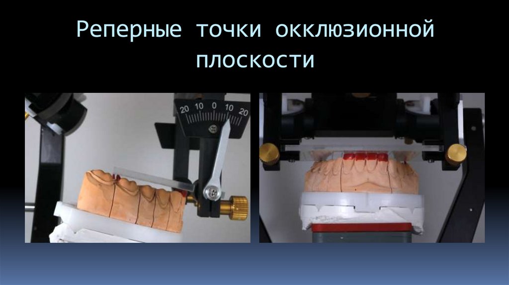 Реперные точки окклюзионной плоскости