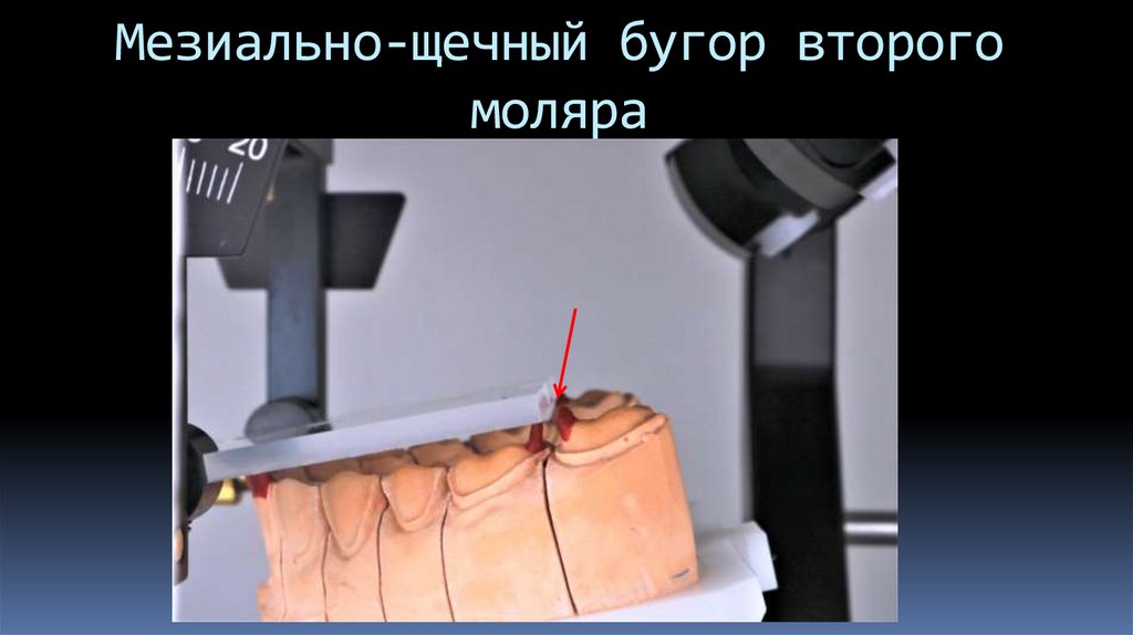 Мезиально-щечный бугор второго моляра