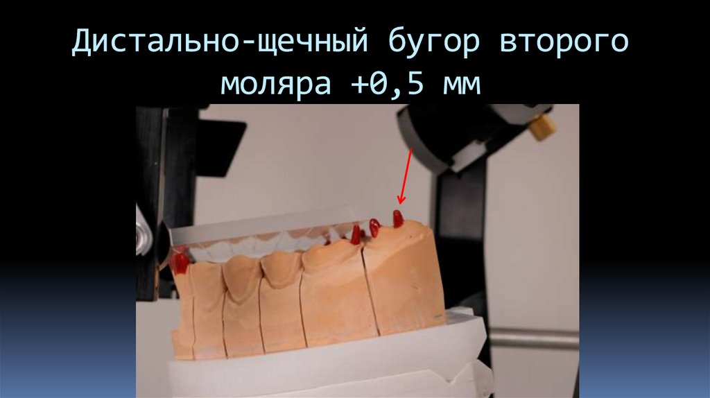 Дистально-щечный бугор второго моляра +0,5 мм