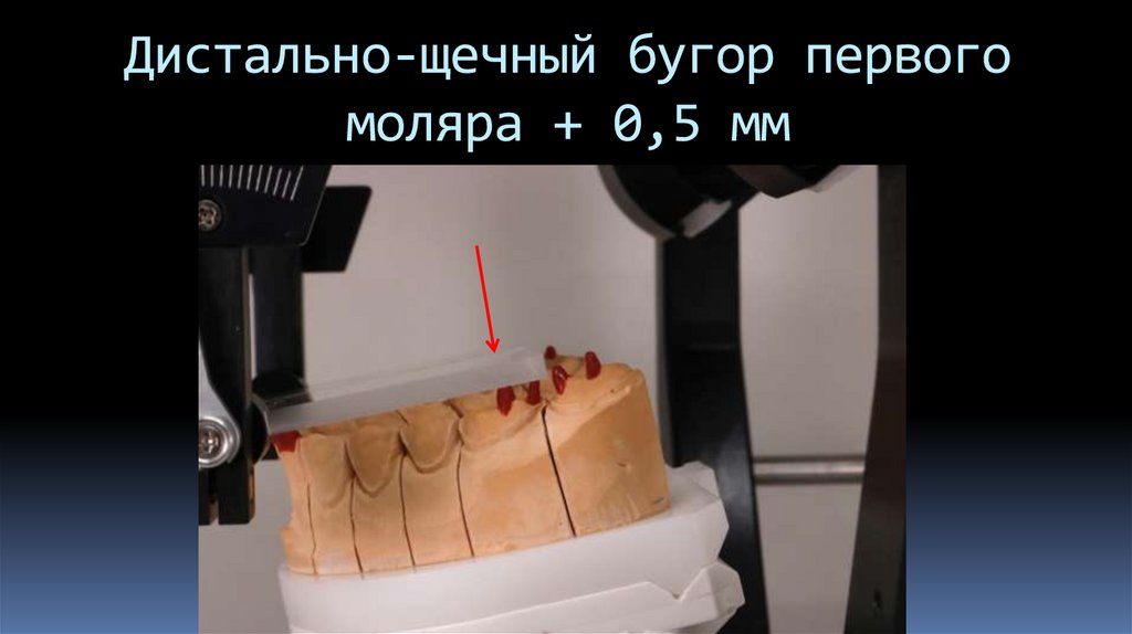 Дистально-щечный бугор первого моляра + 0,5 мм