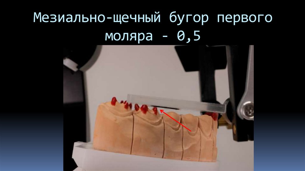 Мезиально-щечный бугор первого моляра - 0,5