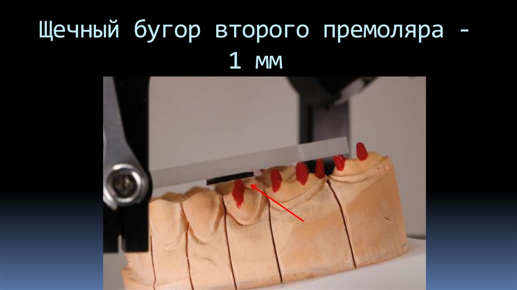 Щечный бугор второго премоляра - 1 мм