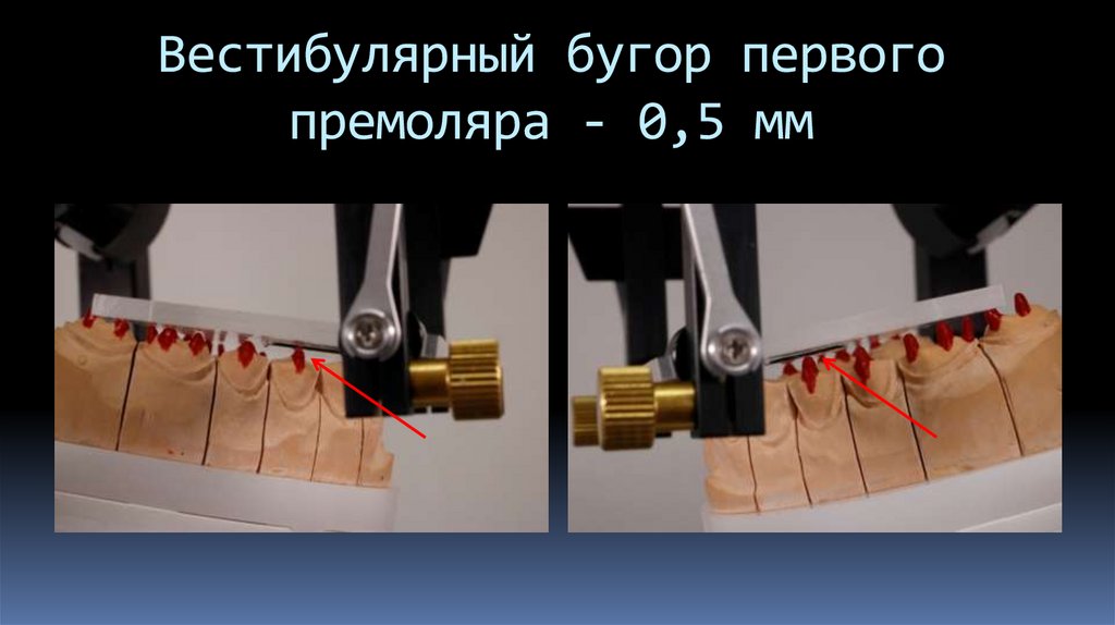 Вестибулярный бугор первого премоляра - 0,5 мм