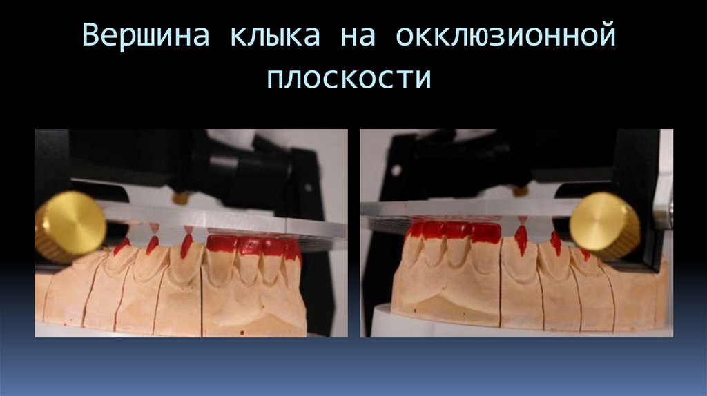 Вершина клыка на окклюзионной плоскости