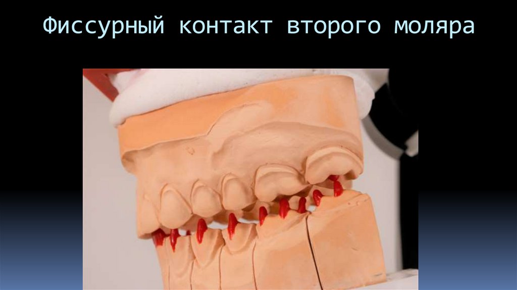 Фиссурный контакт второго моляра