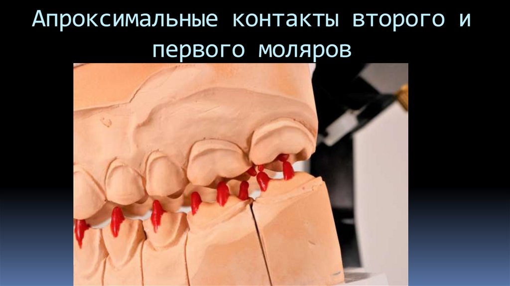 Апроксимальные контакты второго и первого моляров
