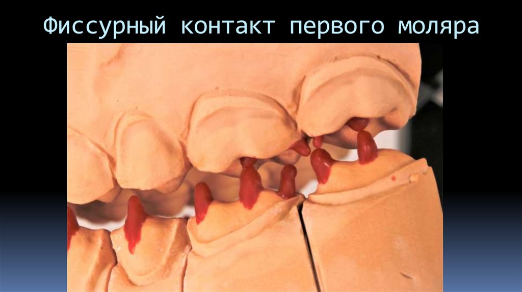 Фиссурный контакт первого моляра