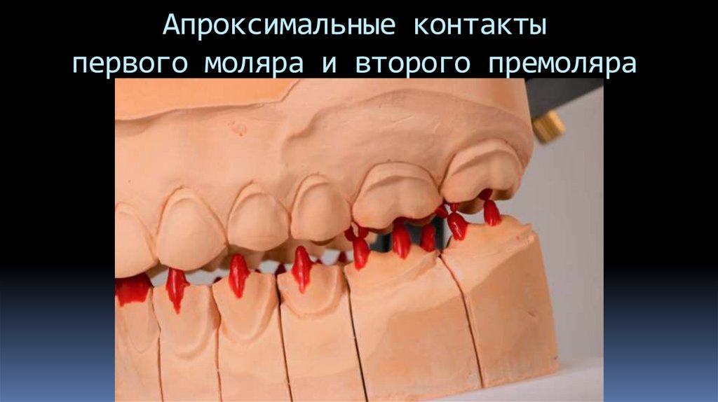 Апроксимальные контакты первого моляра и второго премоляра