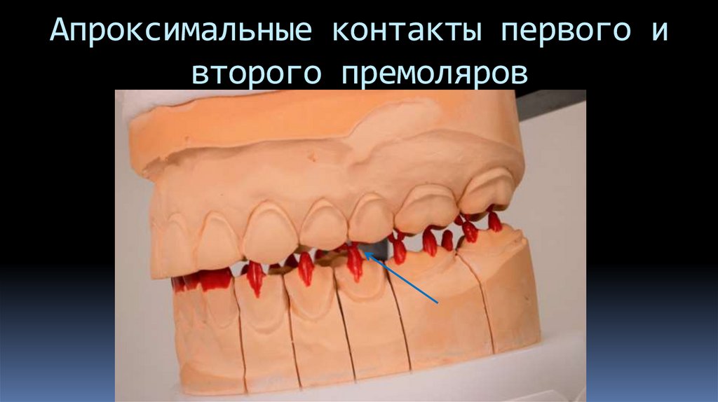 Апроксимальные контакты первого и второго премоляров