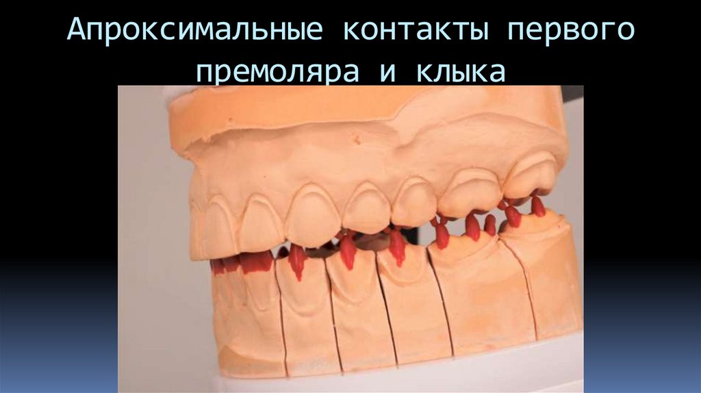Апроксимальные контакты первого премоляра и клыка
