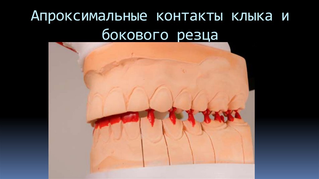 Апроксимальные контакты клыка и бокового резца