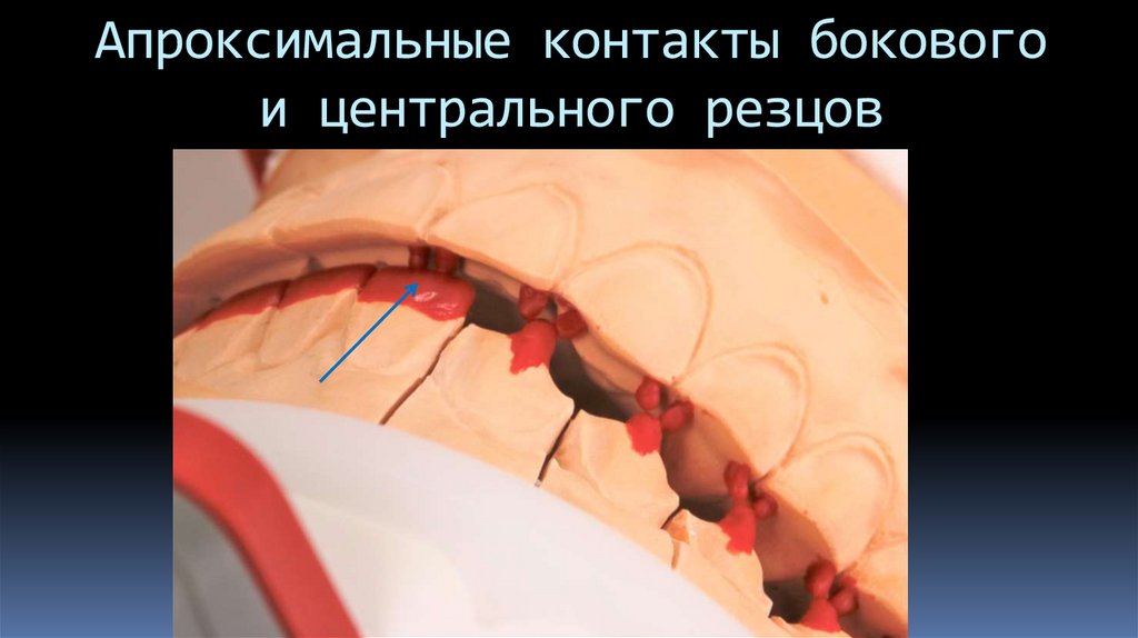 Апроксимальные контакты бокового и центрального резцов