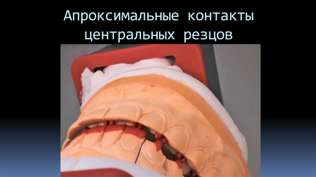 Апроксимальные контакты центральных резцов