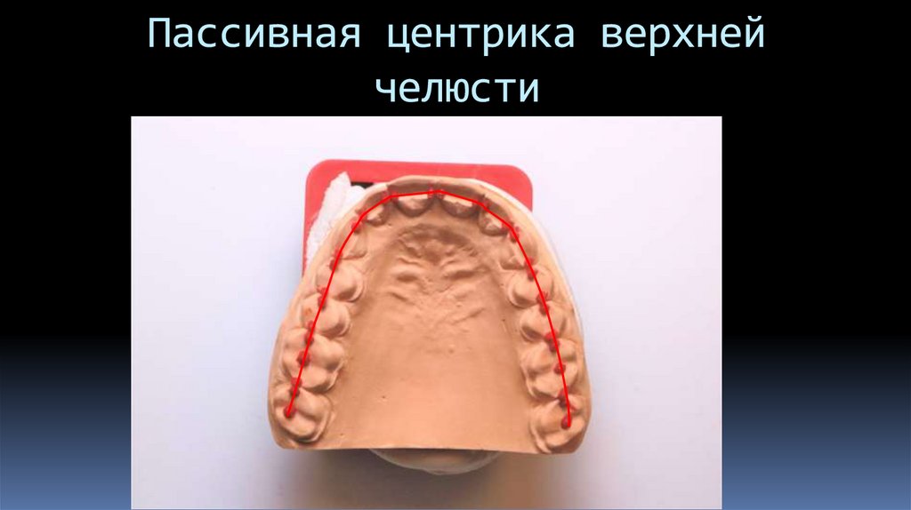 Пассивная центрика верхней челюсти