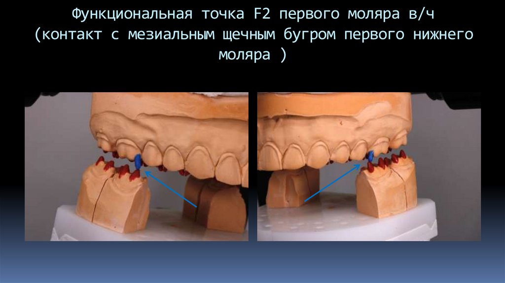 Функциональная точка F2 первого моляра в/ч (контакт с мезиальным щечным бугром первого нижнего моляра )