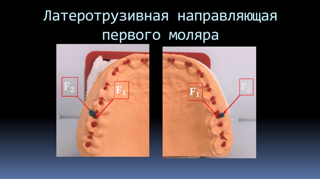 Латеротрузивная направляющая первого моляра