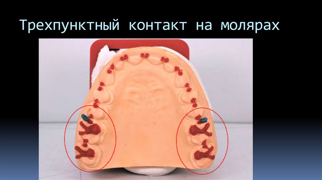 Трехпунктный контакт на молярах