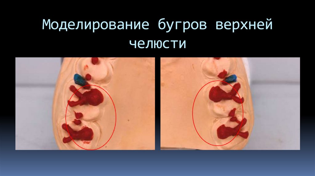 Моделирование бугров верхней челюсти