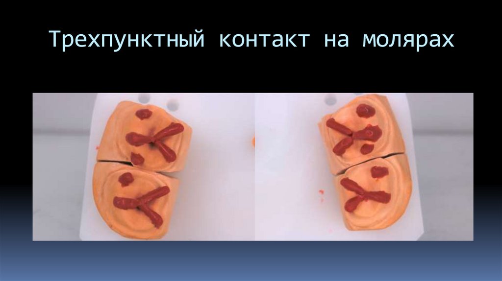 Трехпунктный контакт на молярах