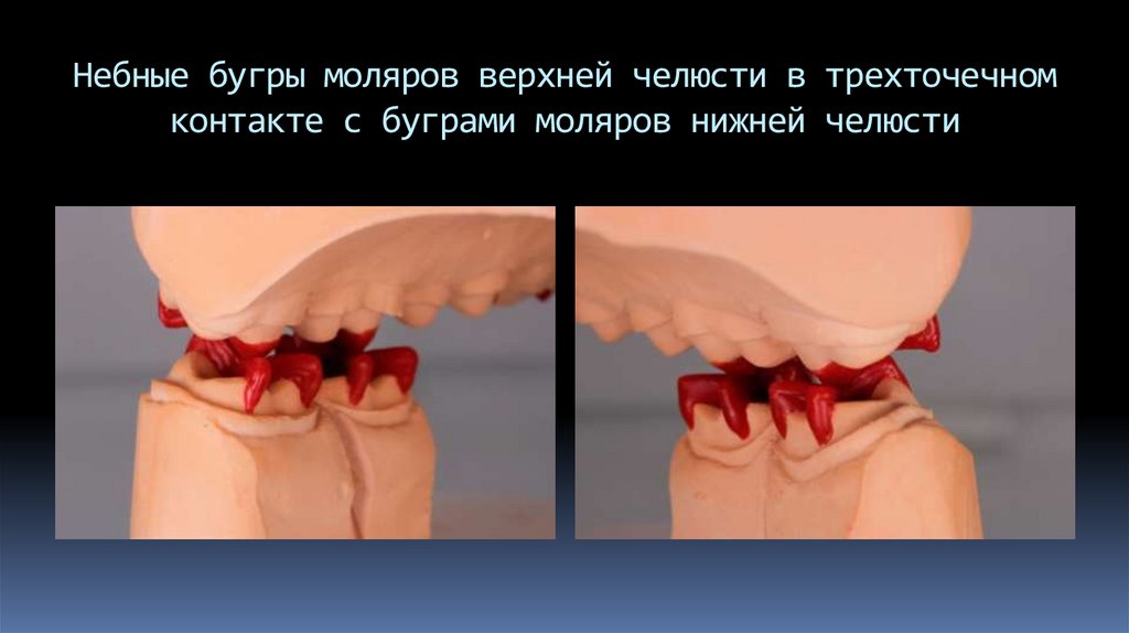 Небные бугры моляров верхней челюсти в трехточечном контакте с буграми моляров нижней челюсти