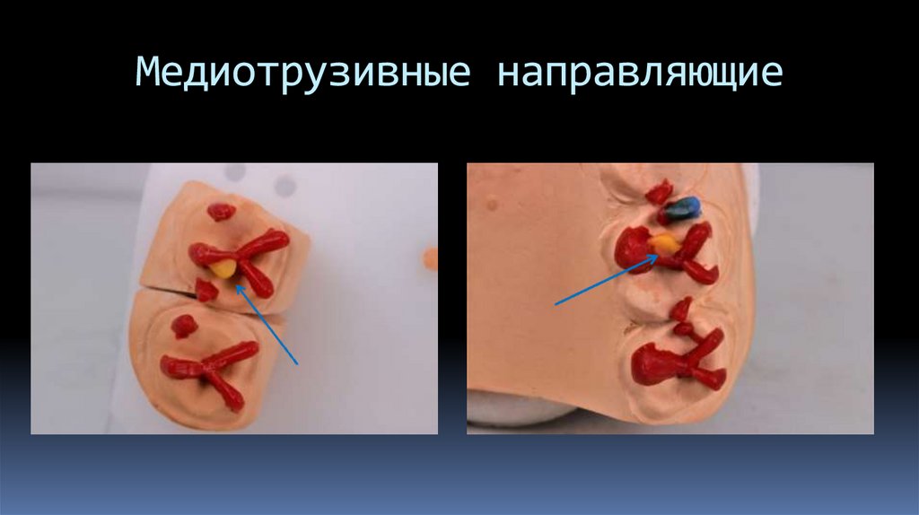 Медиотрузивные направляющие
