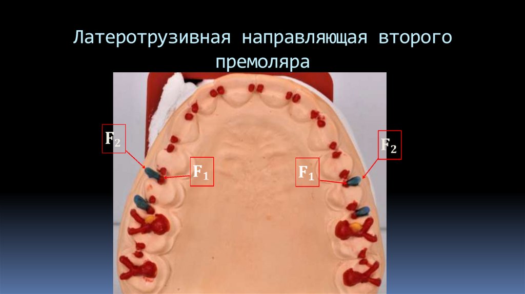 Латеротрузивная направляющая второго премоляра