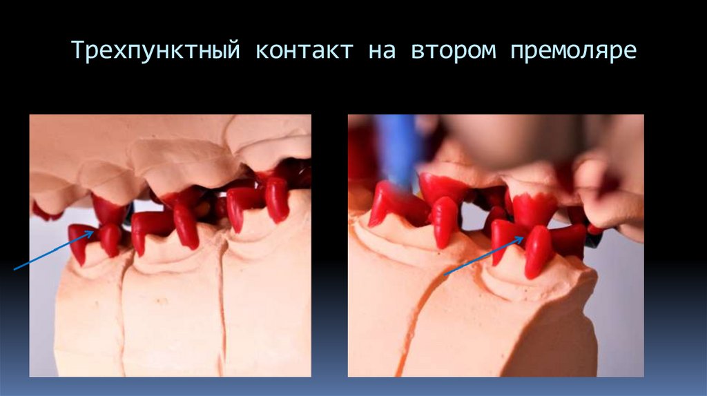 Трехпунктный контакт на втором премоляре