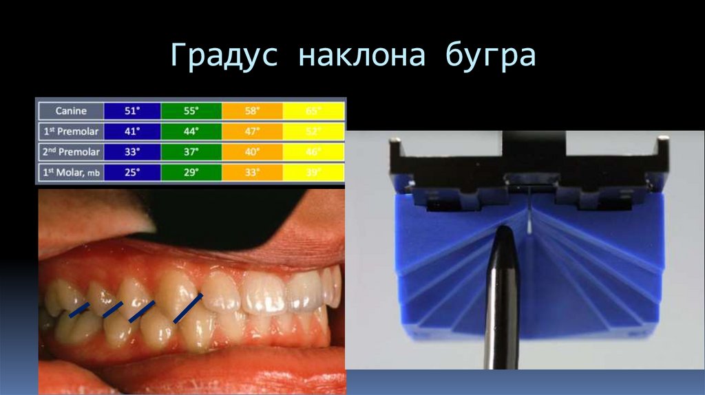 Градус наклона бугра