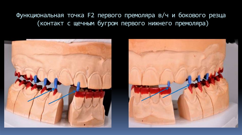 Функциональная точка F2 первого премоляра в/ч и бокового резца (контакт с щечным бугром первого нижнего премоляра)